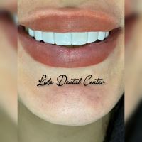 لمینت اقساطی تهران