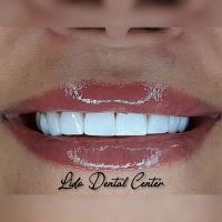 لمینت اقساطی تهران