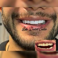 لمینت اقساطی تهران