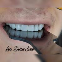 لمینت اقساطی تهران