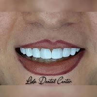 لمینت اقساطی تهران