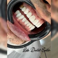 لمینت اقساطی تهران