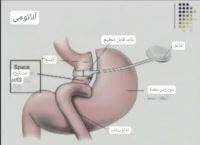 جراحی بای پس معده تهران