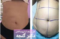 بهترین جراح اسلیو معده تهران