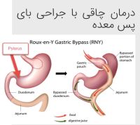 بوتاکس معده تهران