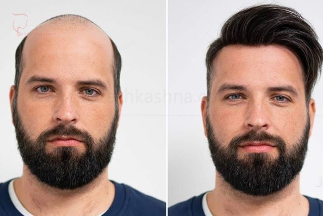 بهترین پروتز مو در کرج