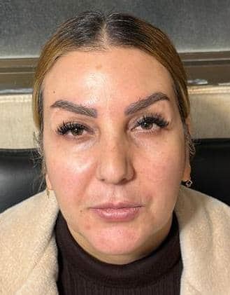 جوانسازی پوست توسط سلولهای بنیادی