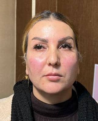 جوانسازی پوست توسط سلولهای بنیادی