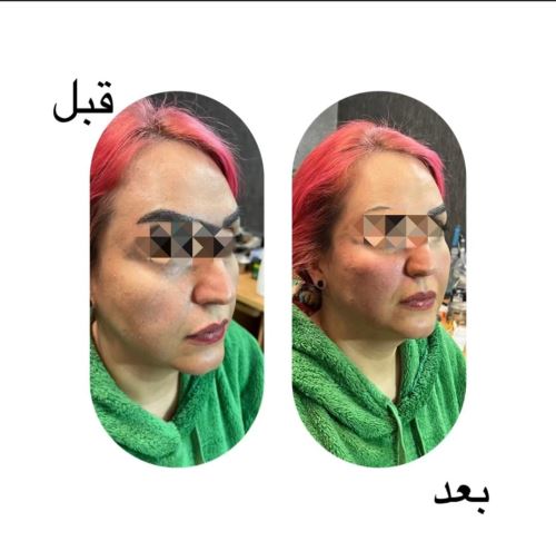 جوانسازی پوست توسط سلولهای بنیادی